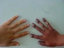 乙酰苯胺类中毒