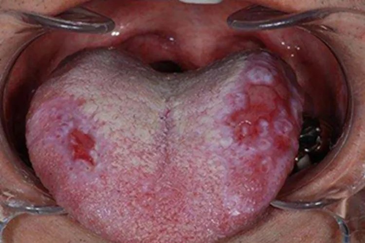 舌扁平苔藓症状图片