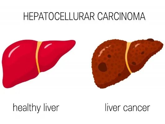 肝癌晚期症状有什么