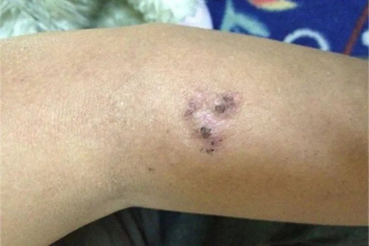 皮肤炭疽胳膊症状图片