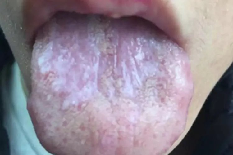 舌扁平苔藓症状图片