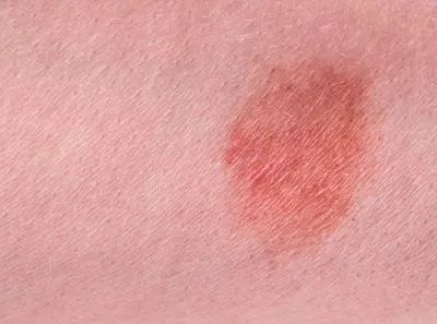 去除红胎记的费用是多少