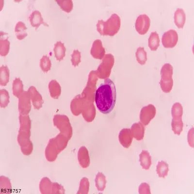 乙型肝炎表面抗原是什么  乙型肝炎表面抗原阳性严重吗