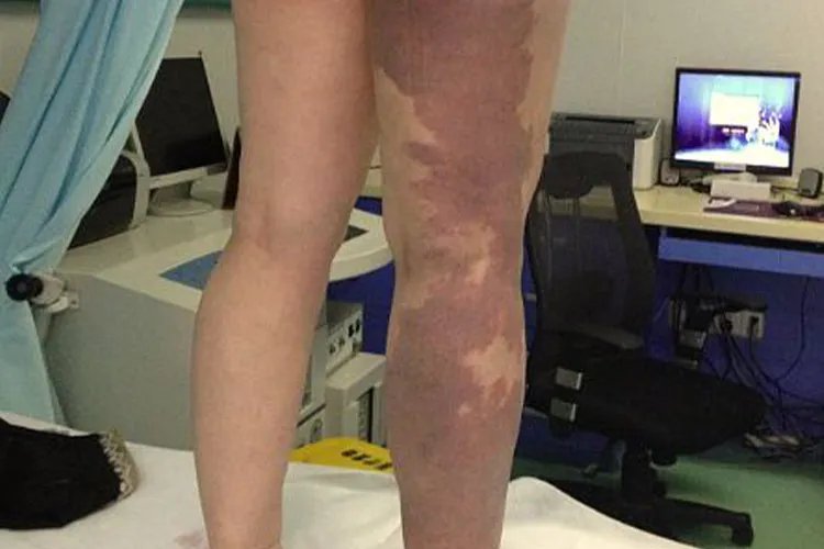 血管瘤有几种类型图片