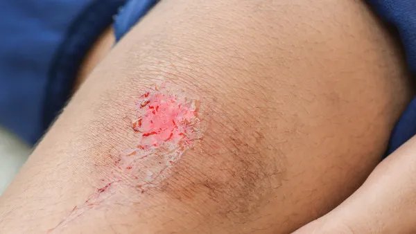 伤口感染化脓怎么办