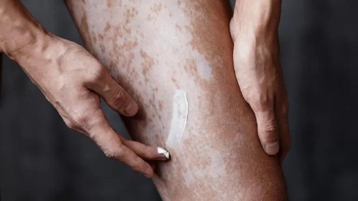 白癜风特效药是什么