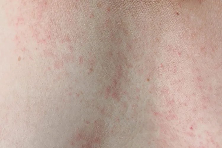 背部常见皮炎图片大全