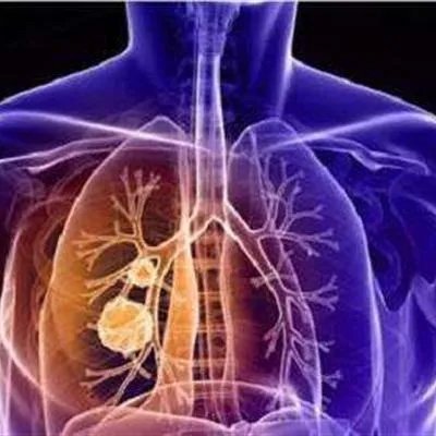 肺鳞癌手术大概多少钱?