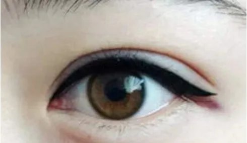 眼部微整形有副作用吗