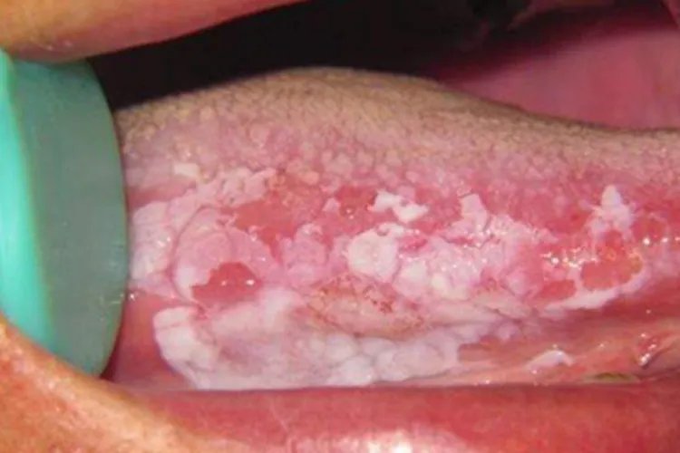 舌扁平苔藓症状图片