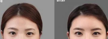 苏州好的丰额头整形医院在哪？