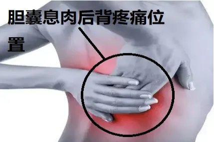 胆囊息肉后背疼痛位置图