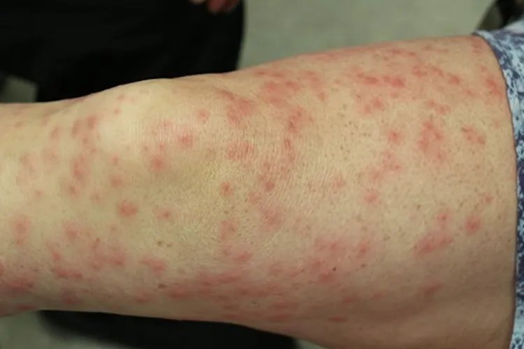 斑丘疹图片