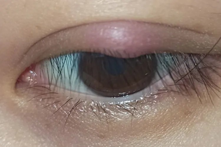 睑板腺炎小疙瘩图片