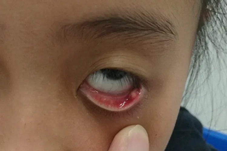 睑板腺炎小疙瘩图片