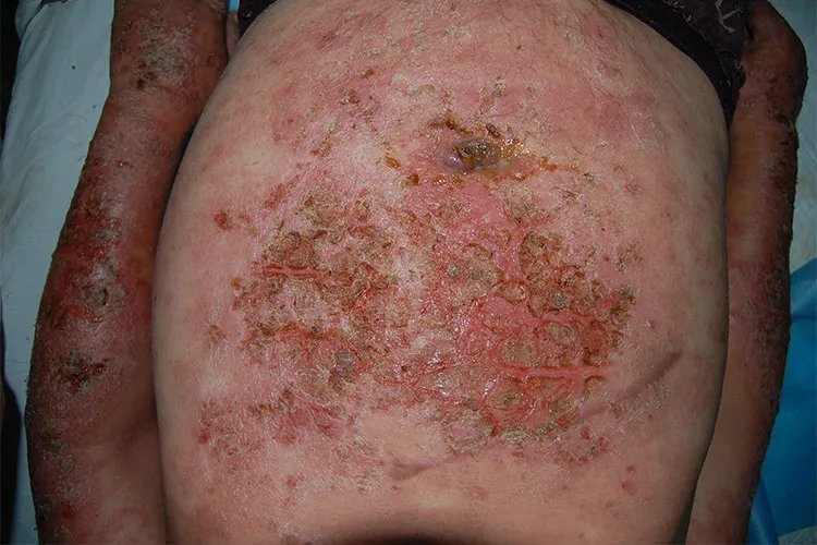 皮炎图片和症状