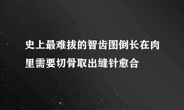 史上最难拔的智齿图倒长在肉里需要切骨取出缝针愈合