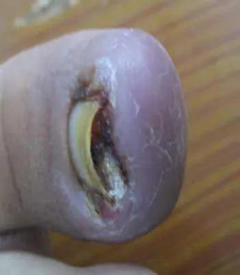 甲沟炎的治疗偏方