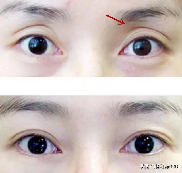 割双眼皮到底好不好？