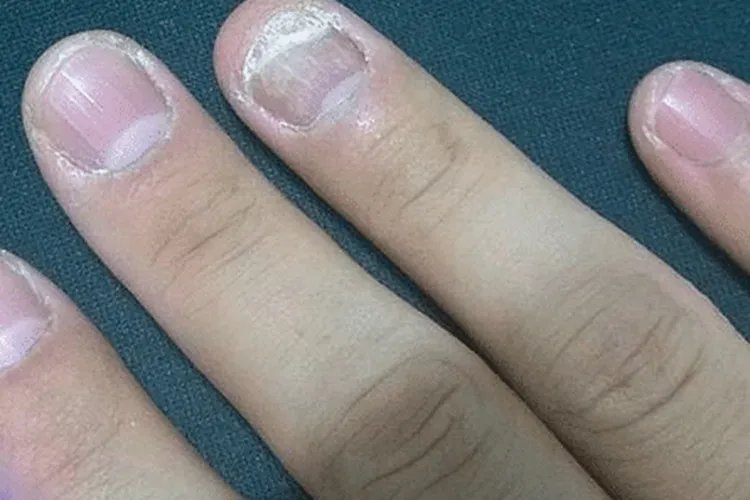 手指甲发白图片原因