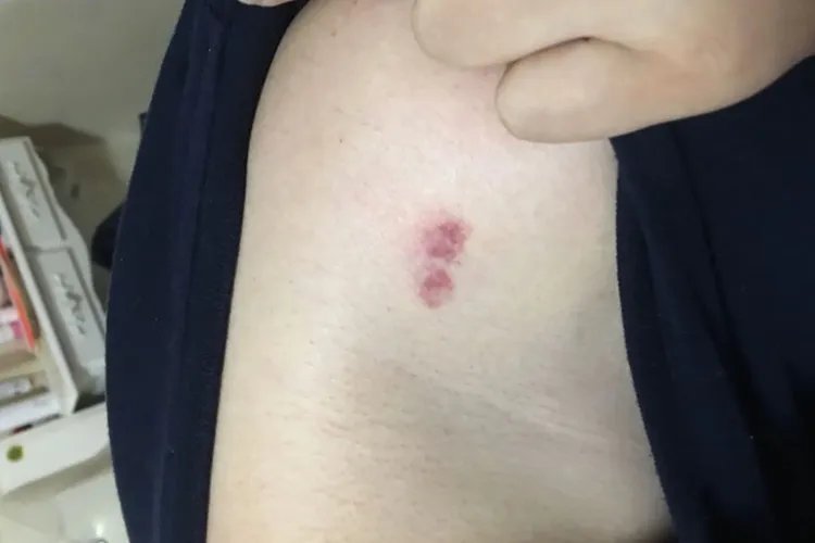 吻痕图片是什么样的