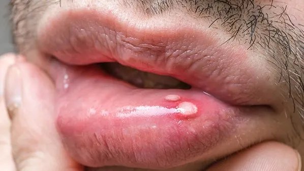 西瓜霜治口腔溃疡吗