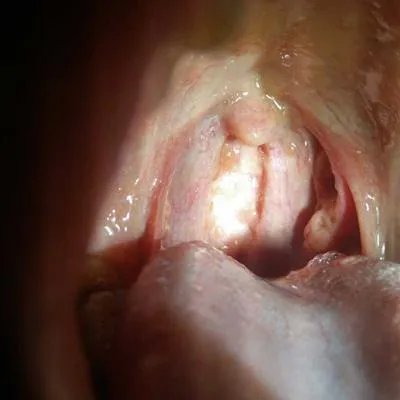 舌头开裂是什么原因?