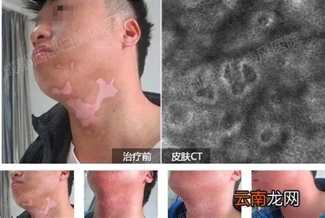 白斑刚开始的图片