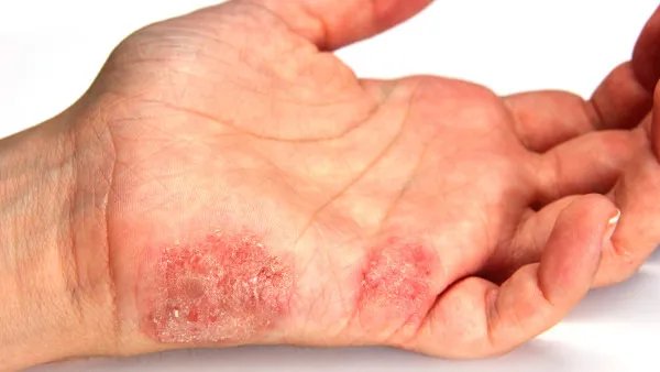 手心出汗是什么原因