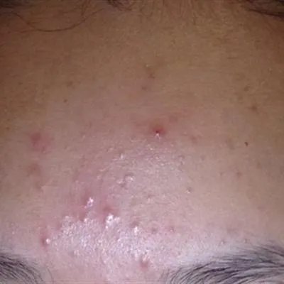 额头长痘怎么治疗