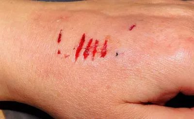 疤痕修复霜的作用有哪些 出现疤痕应该怎么去除