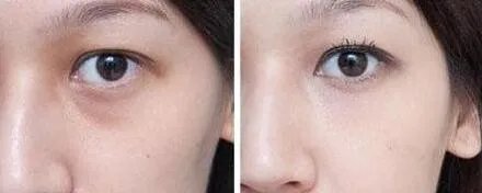 无痕去眼袋的优缺点