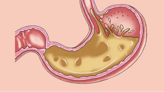 胃食管反流是怎么回事