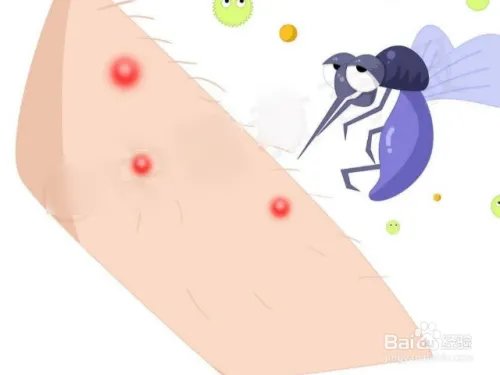 被恙螨咬了怎么处理？