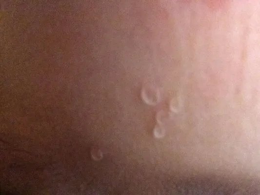 扁平疣最佳治疗方法是什么？