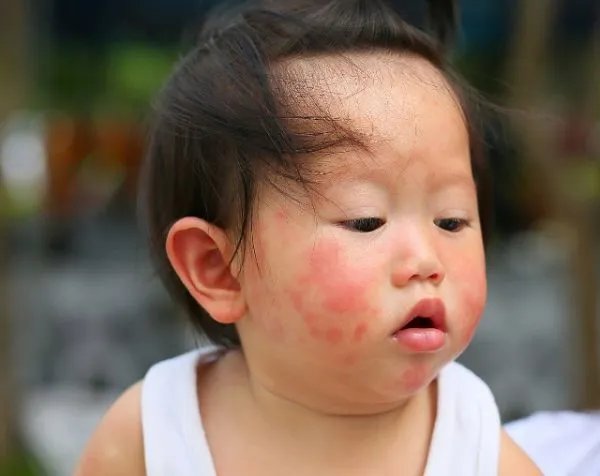 宝宝对奶粉过敏怎么办?