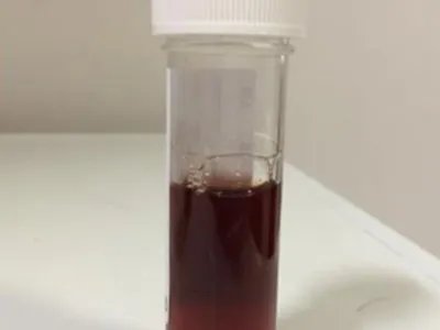 冷凝集素综合征腹部酱油色尿图片