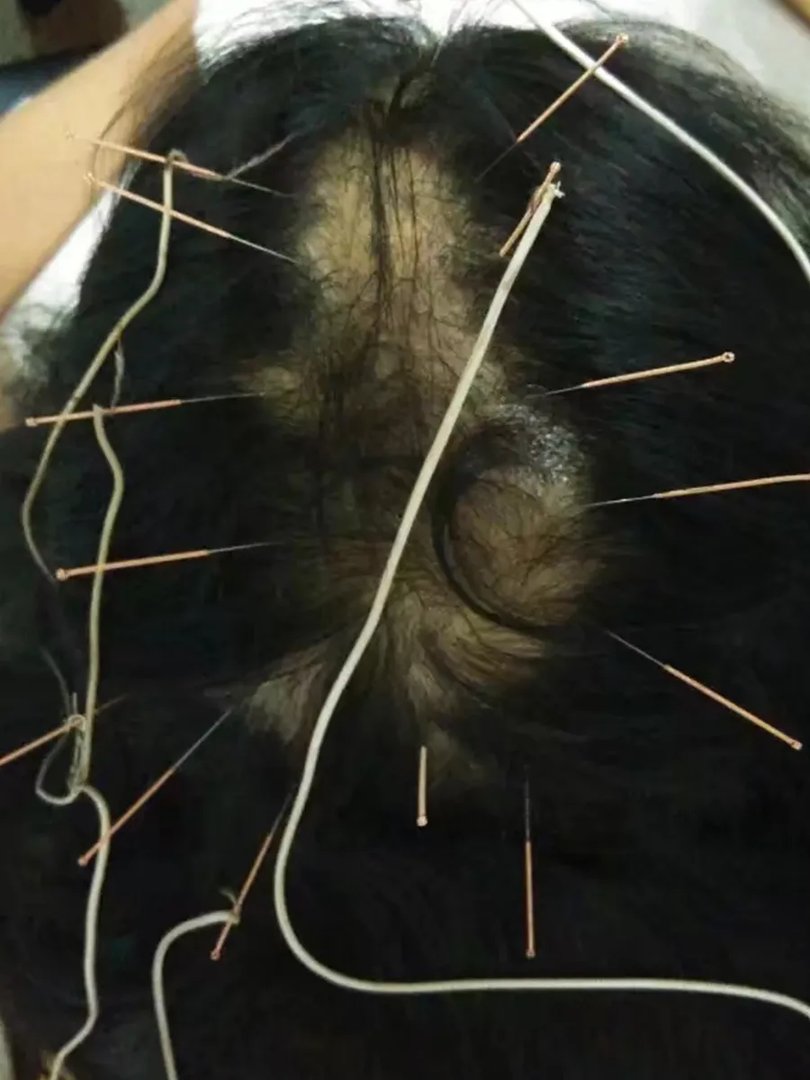 17岁女孩因学习压力较大，竟患上拔毛癖！