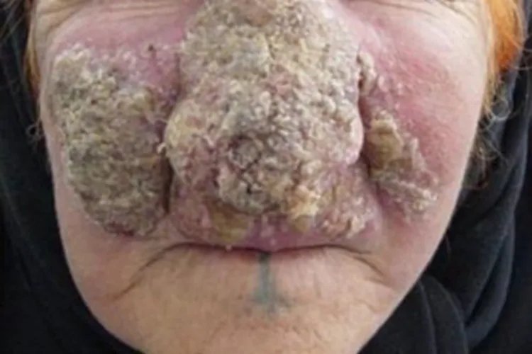 皮肤利什曼病面部症状图片