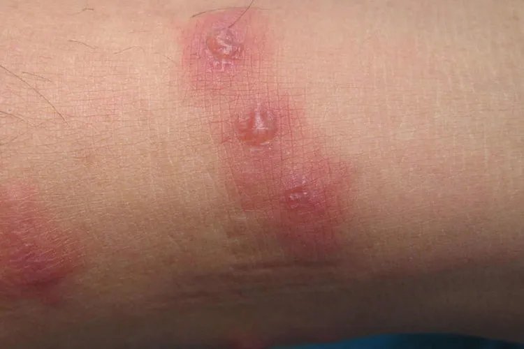 如何鉴别被蜱虫咬了皮肤小结节图片
