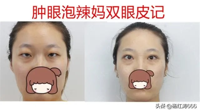 割双眼皮到底好不好？