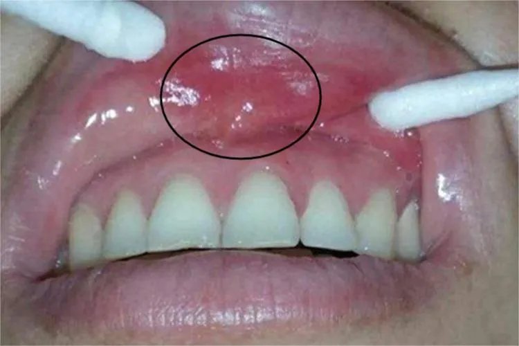 口腔黏膜结核性溃疡小红疙瘩图片