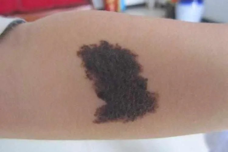 黑色素胎记图片