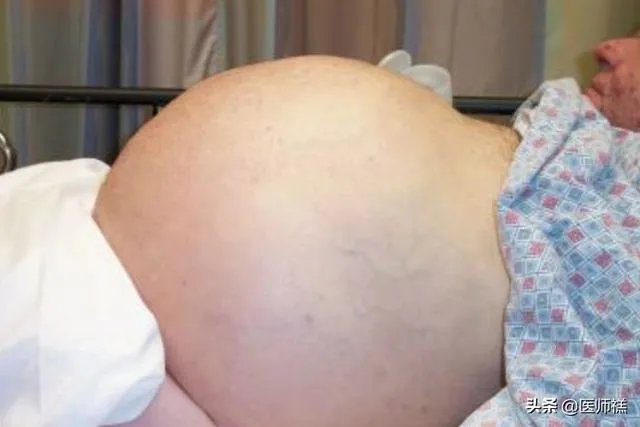 肝硬化前兆有哪些症状？