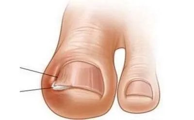 甲沟炎的治疗偏方