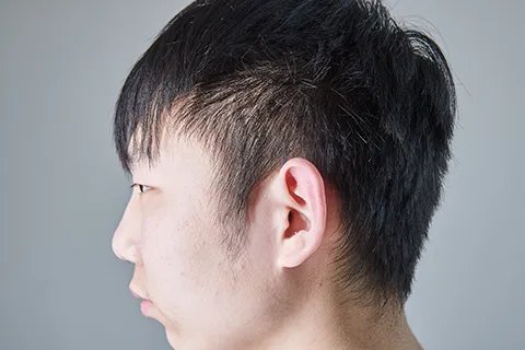 鬓角长痘是哪个器官不好