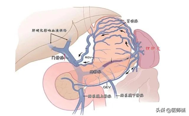 肝硬化前兆有哪些症状？