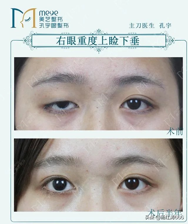 割双眼皮到底好不好？