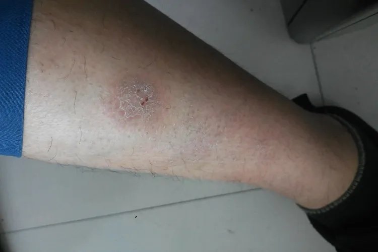 皮肤干燥症小腿结痂图片