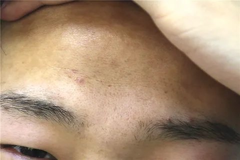 黑色素瘤早期症状有哪些